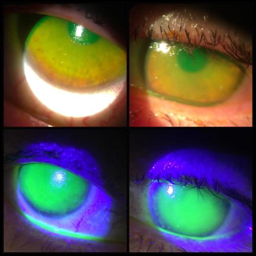 Cornea - deepitelisation - the patient accidentaly stored her contact lenses in the make-up remover instead of the contact lens solution